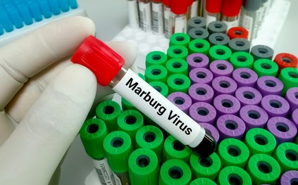 إصابات بفيروس «ماربورغ» في غينيا الاستوائية وتنزانيا.. وهذه أبرز أعراضه
