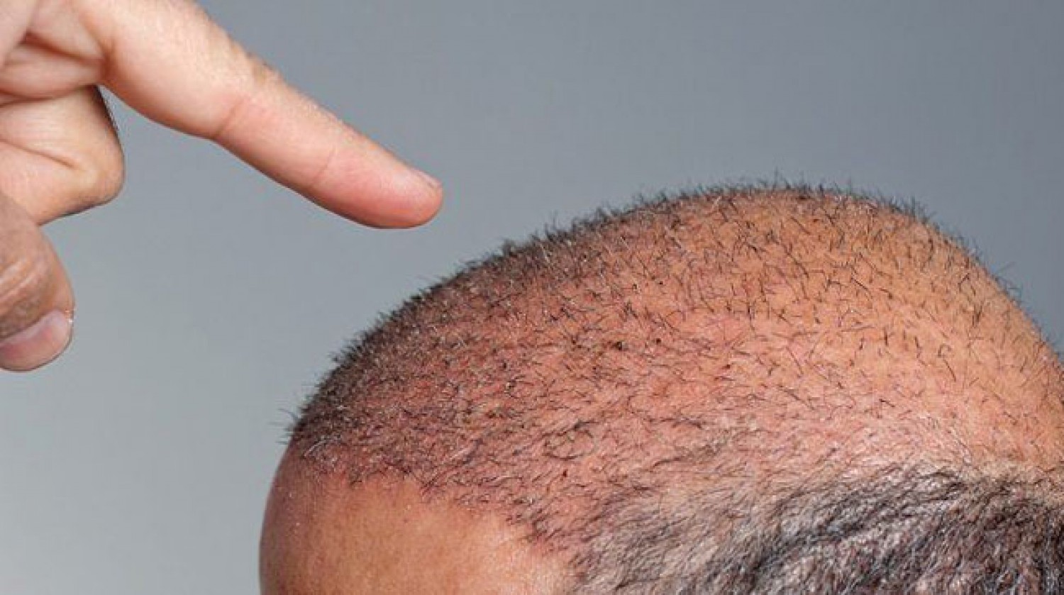 دليلك الشامل لأنواع زراعة الشعر وأضرارها الرجل